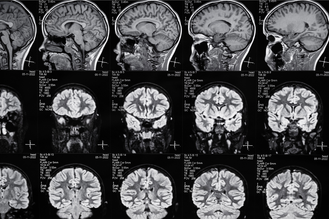 Brain Scan Portage, IN