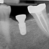dental implants in stamford, CT
