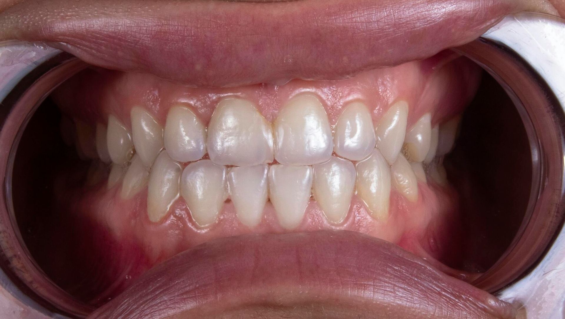 Close-up of human teeth, showing a full, aligned set. The teeth are white with pink gums visible.