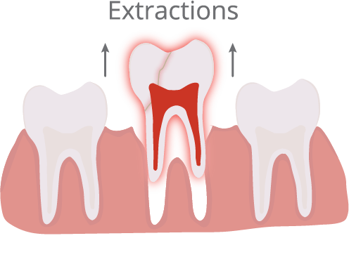 Tooth extractions in Clemmons NC