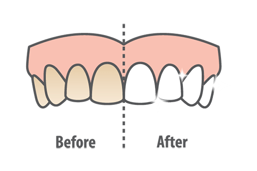 Veneers and Teeth Whitening