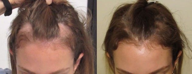 female pattern baldness with receding temples before and after pictures