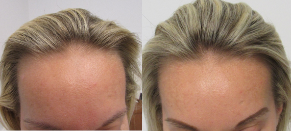 Female hair regrowth 9 months front