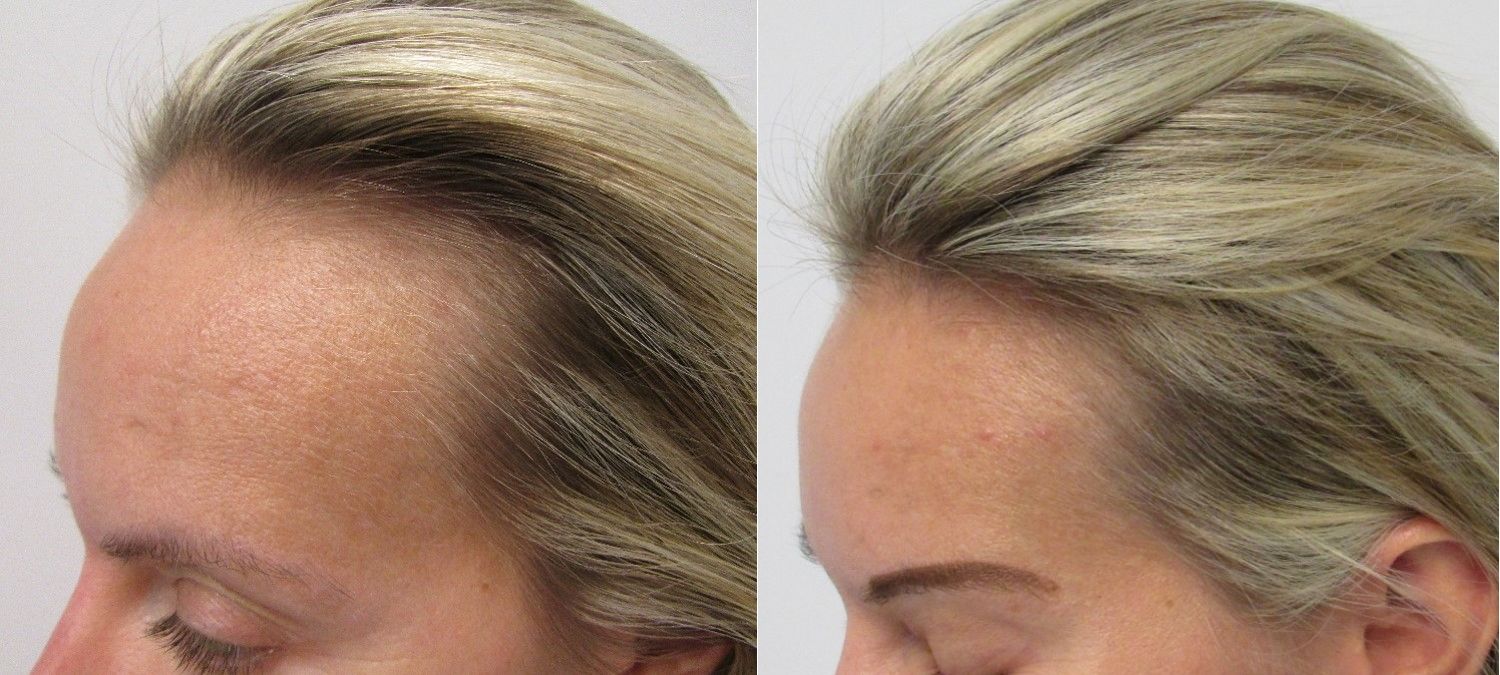Female hair regrowth before and after pictures 9 months side
