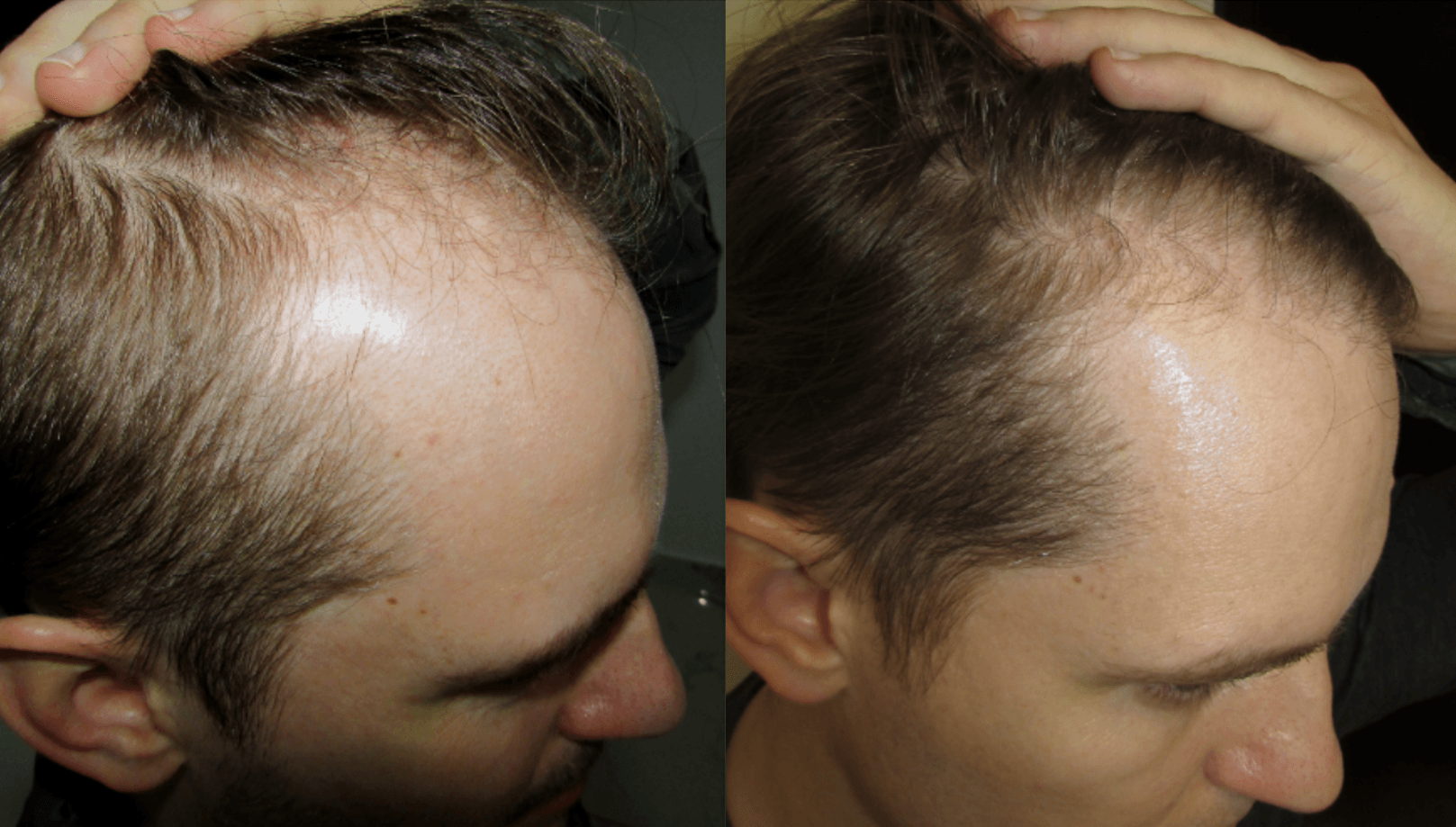 temples hair regrowth - stop and regrow works the best