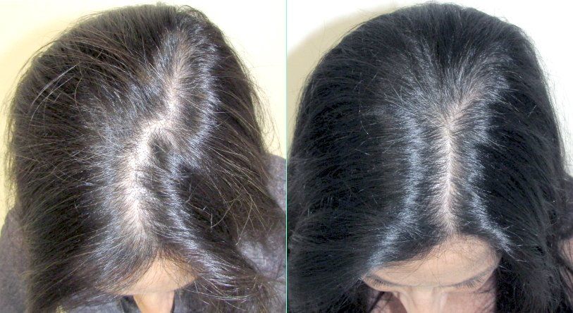 stop and regrow before and after prics - female