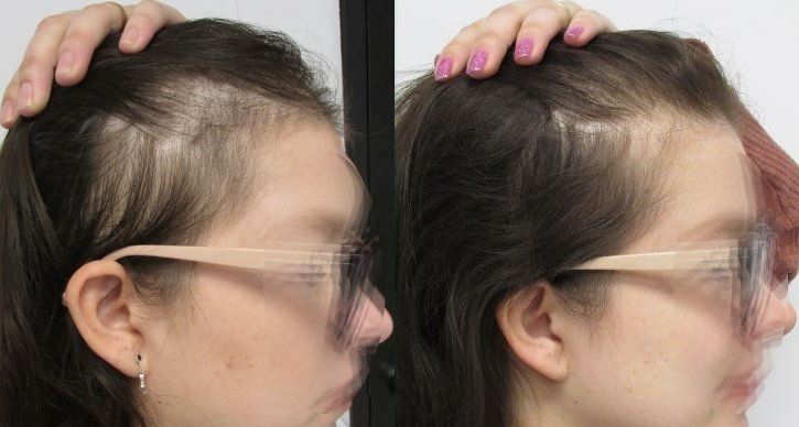female pattern baldness with receding temples before and after pictures