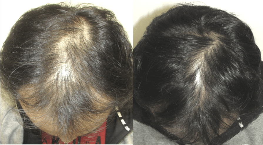 diffuse thinning before and after picture hiro japanese hair