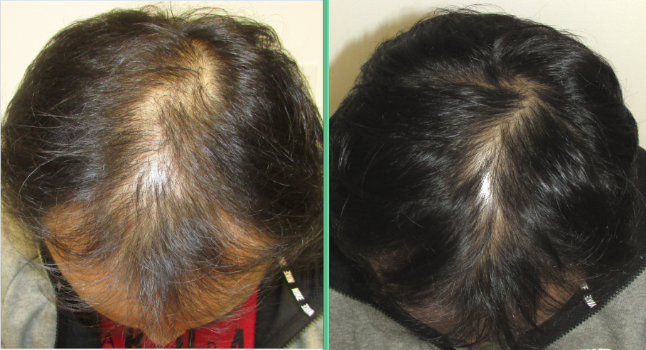 best hair regrowth program - proof stop and regrow works
