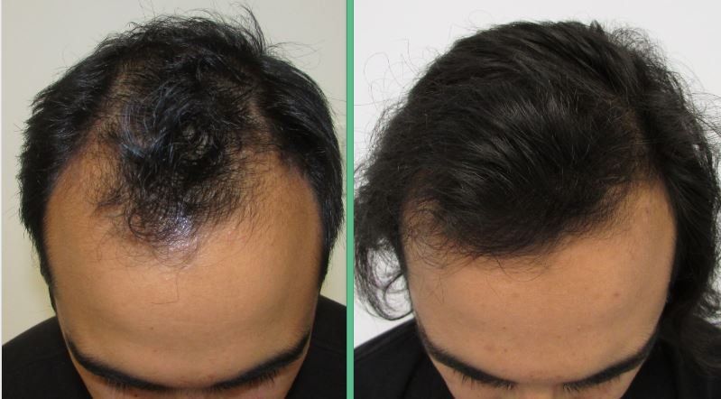 12 months hair regrowth - stop and regrow