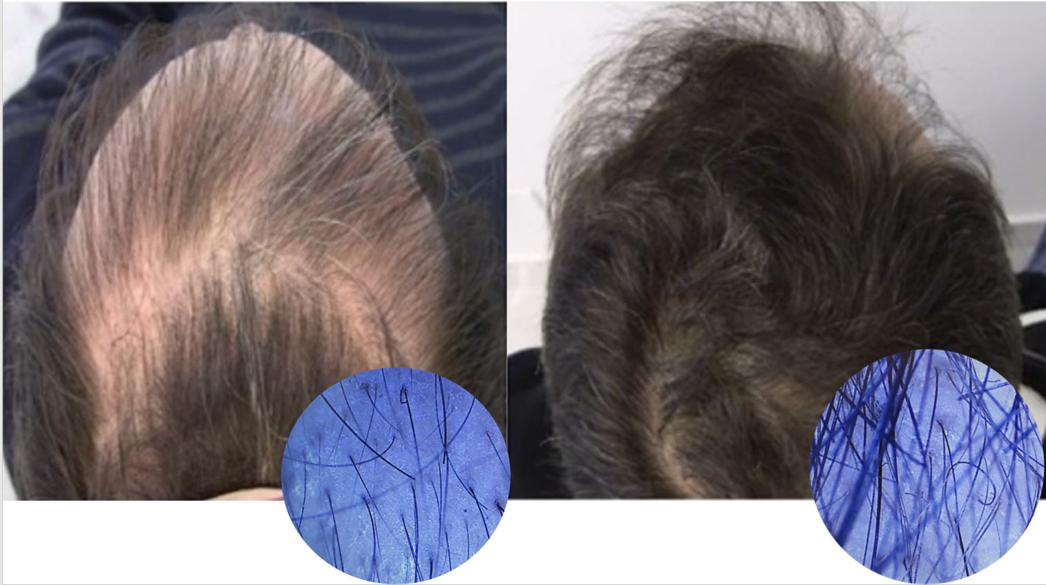 21 Months of Stop and regrow treatment for hair loss