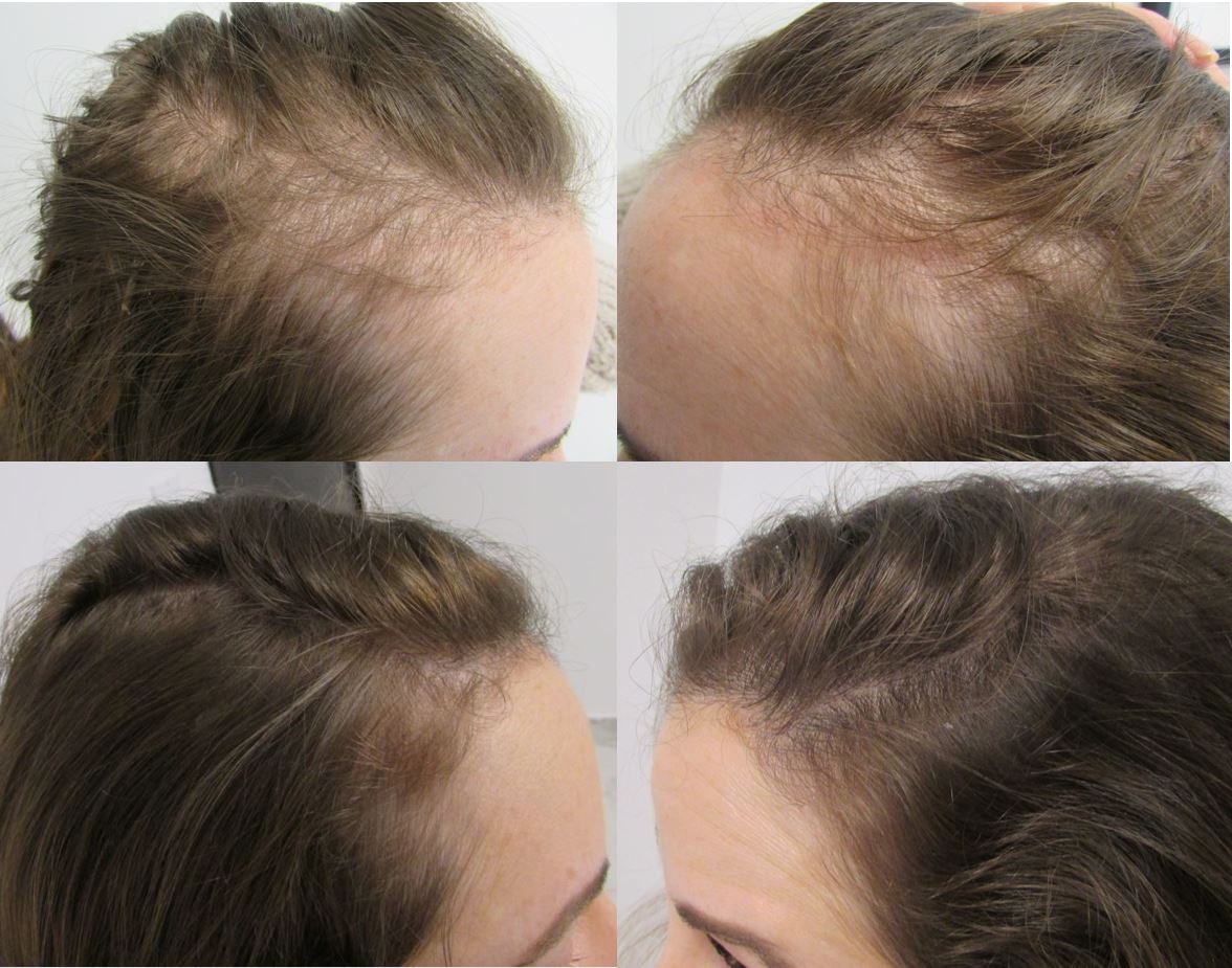 22 Months of Women's Thin Hair Treatment with Stop and reGrow