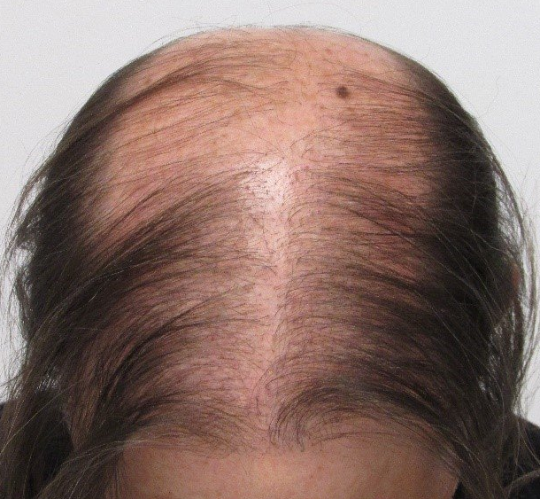 biggest hair transplant myths - actually hair transplant case - after 2 transplants