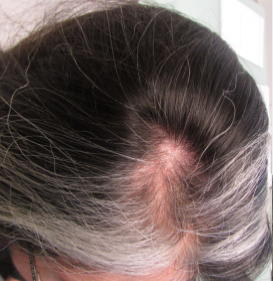 Alopecia Areata: What It Is, What Causes It, and How to Treat It for Full Hair Regrowth