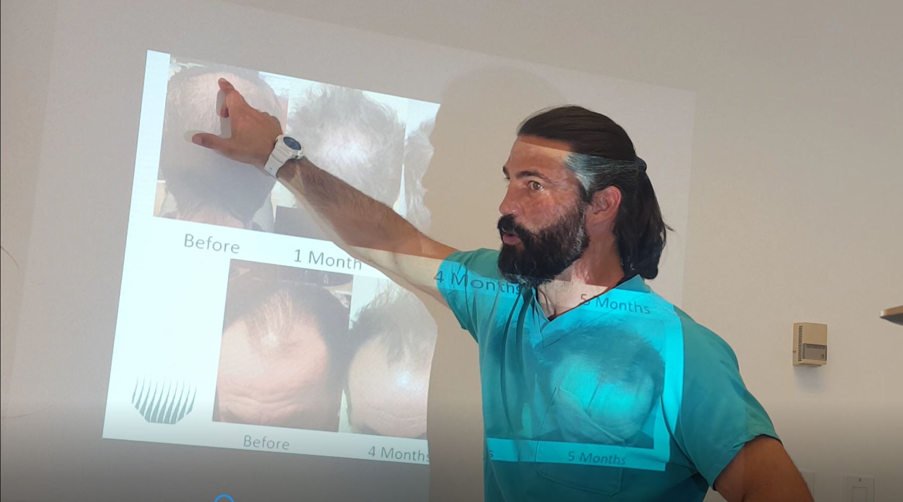 The four stages of hair loss and how to stop it