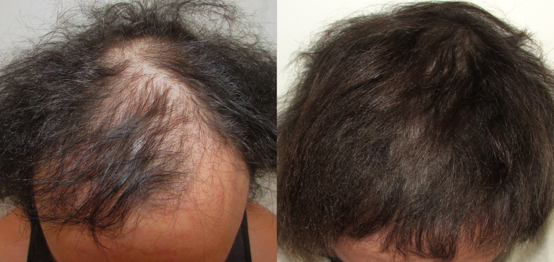 hollyword hair regrowth - stop and regrow