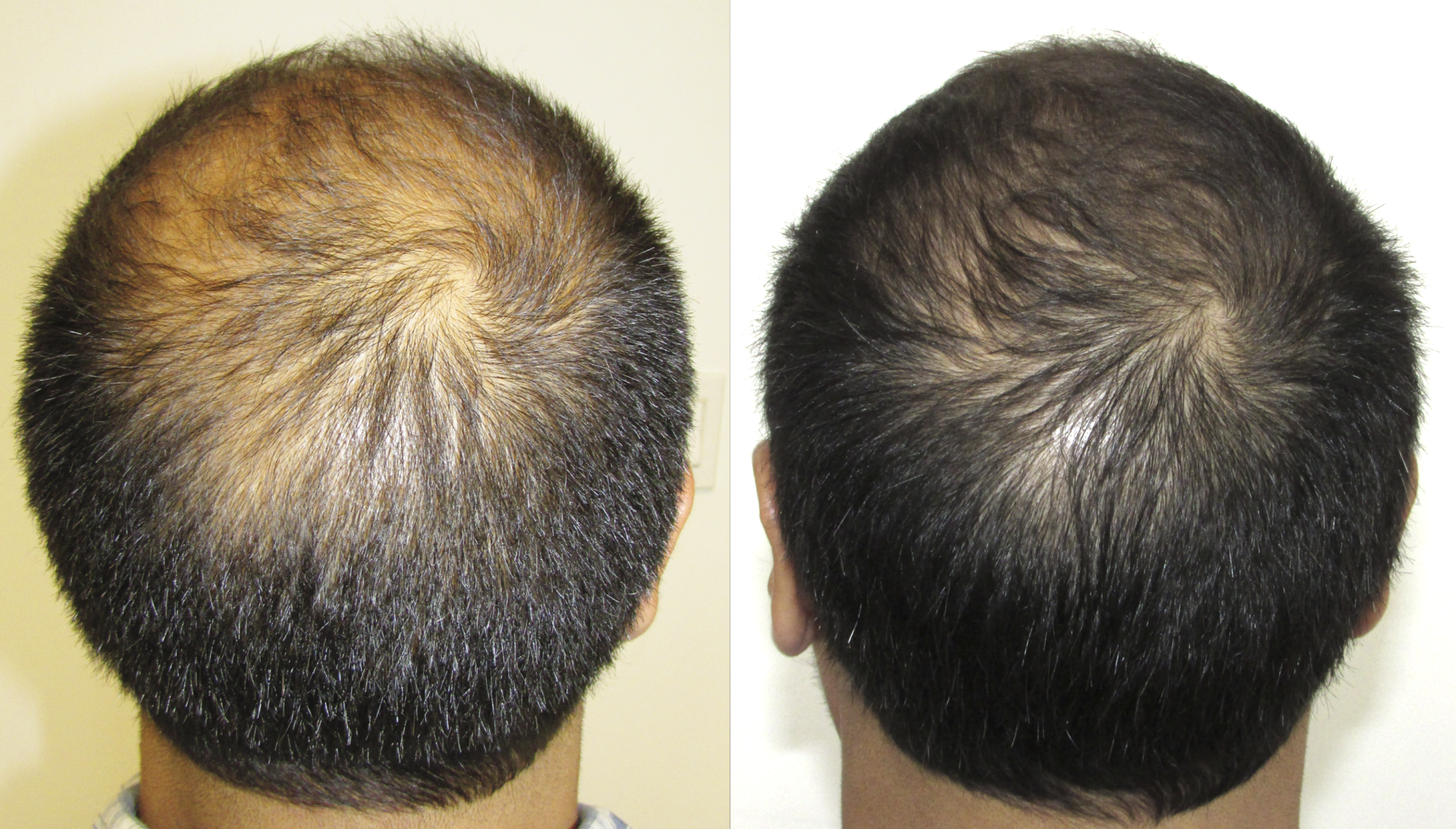 balding crown hair regrows from the outside in - before and after