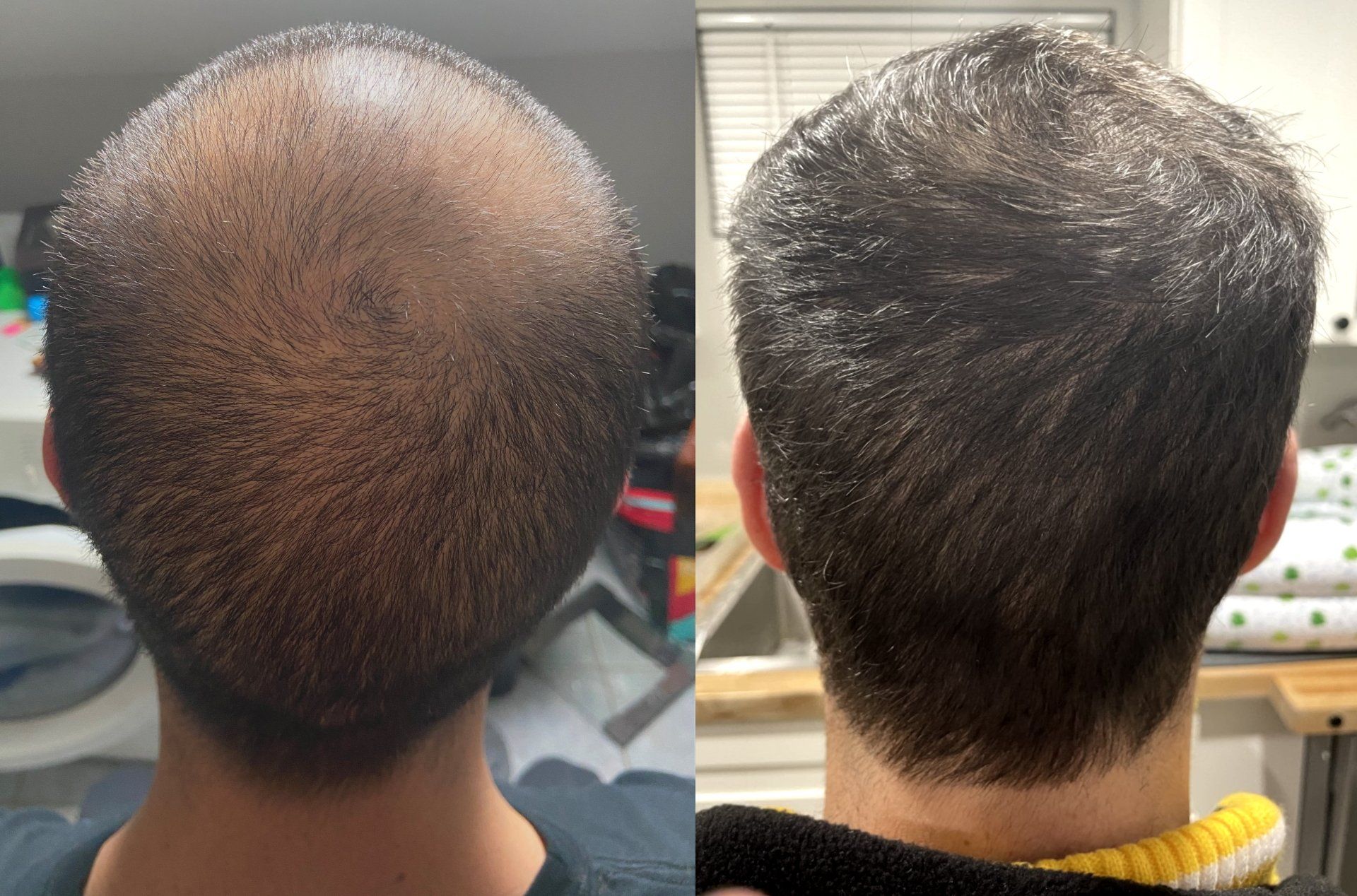12 months hair regrowth - doing great now
