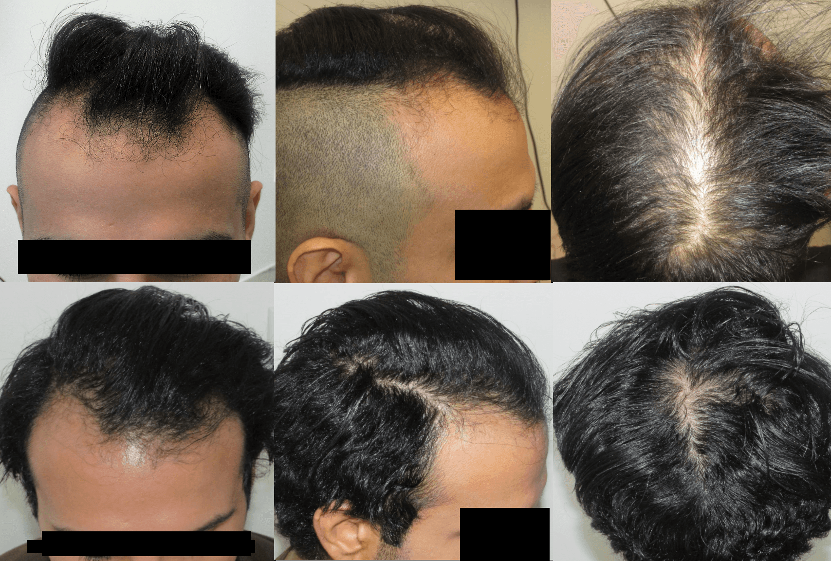 Best receding hair loss treatment for male pattern baldness