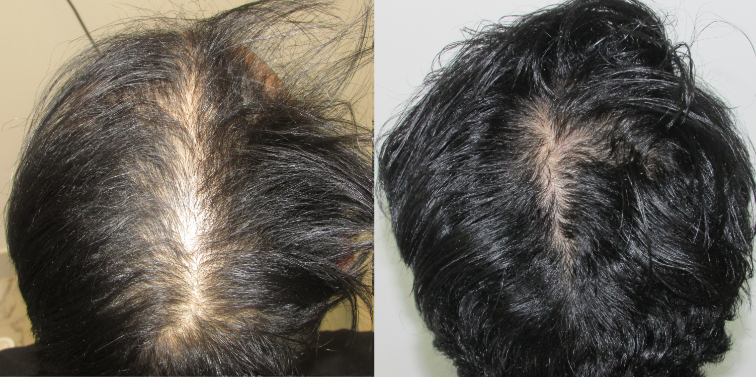 Best hair growth product