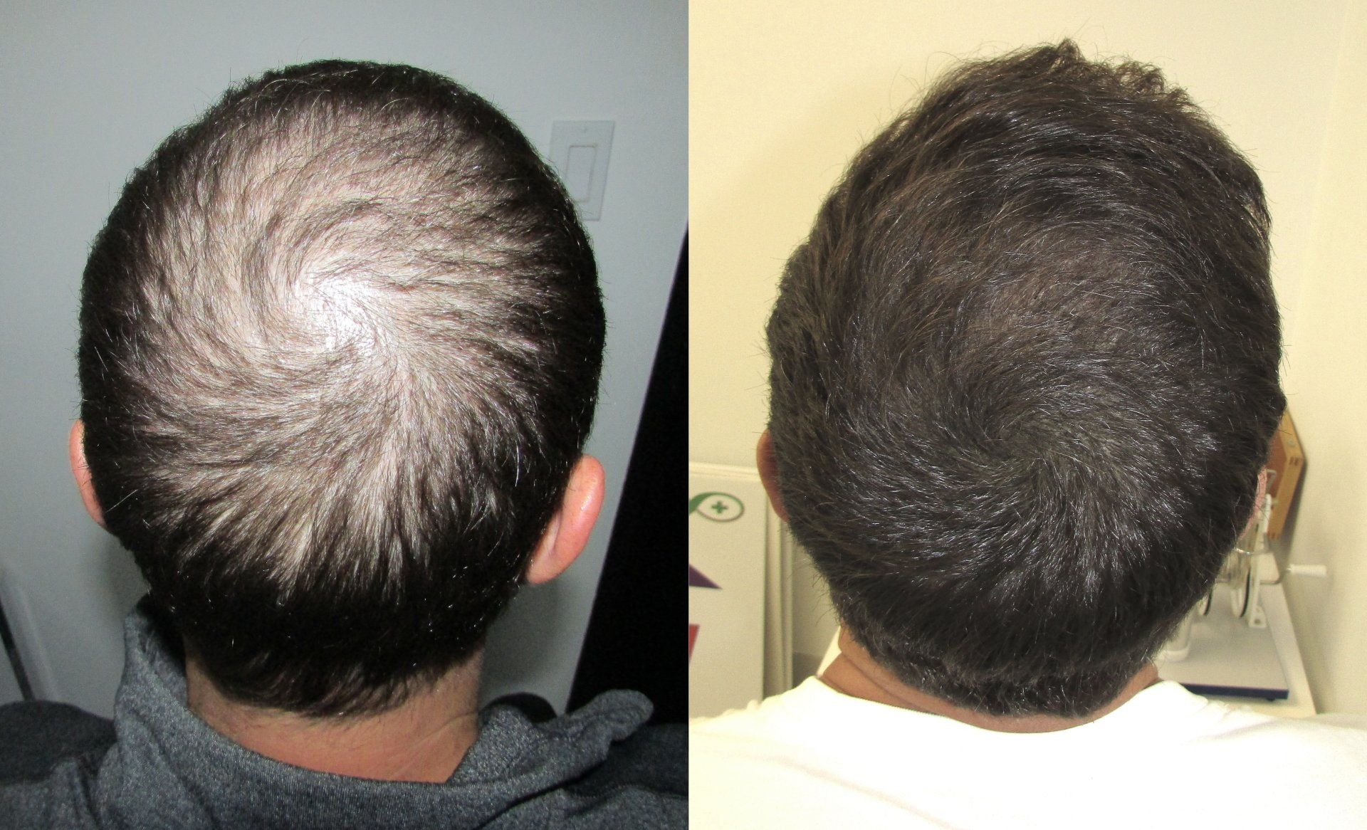 crown hair regrowth story before and afters
