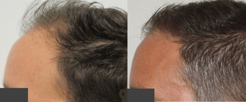 how much hair can you regrow in 3 years?  stop and regrow