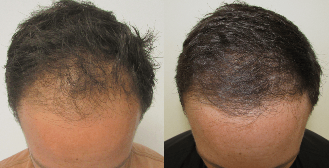 hair regrowth improvement - stop and regrow