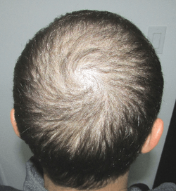 # Best Hair Regrowth Program | Stop and Regrow by Dr Nettles