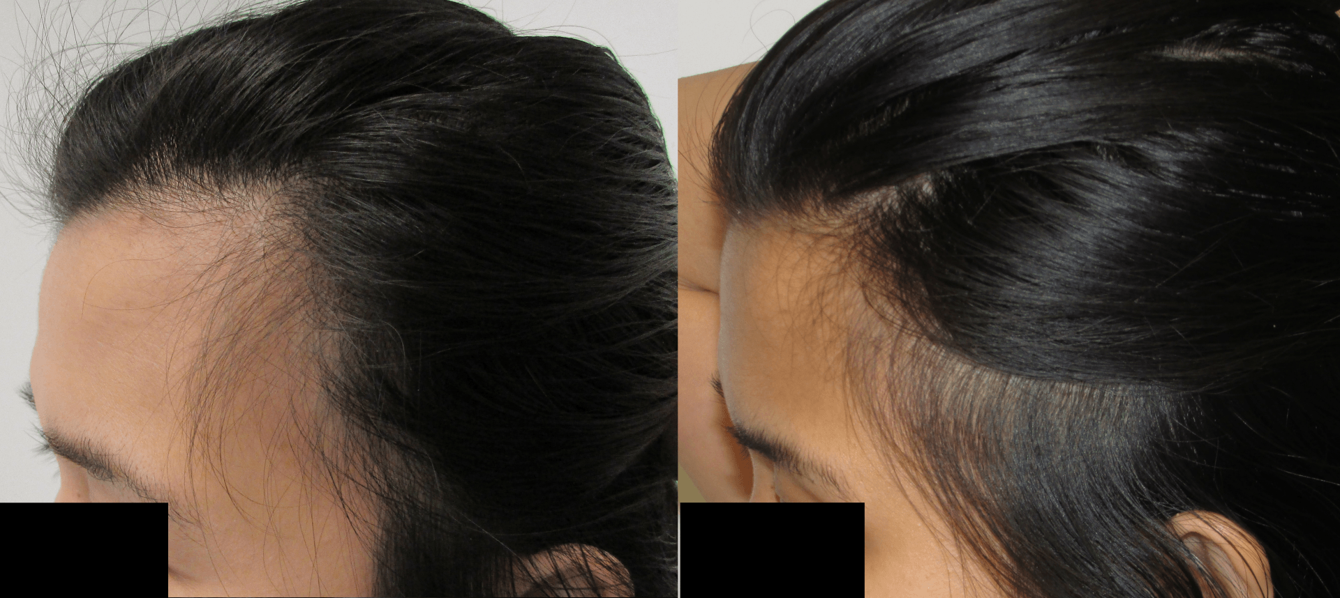 Female temples hair regrowth 9 months side - Karan