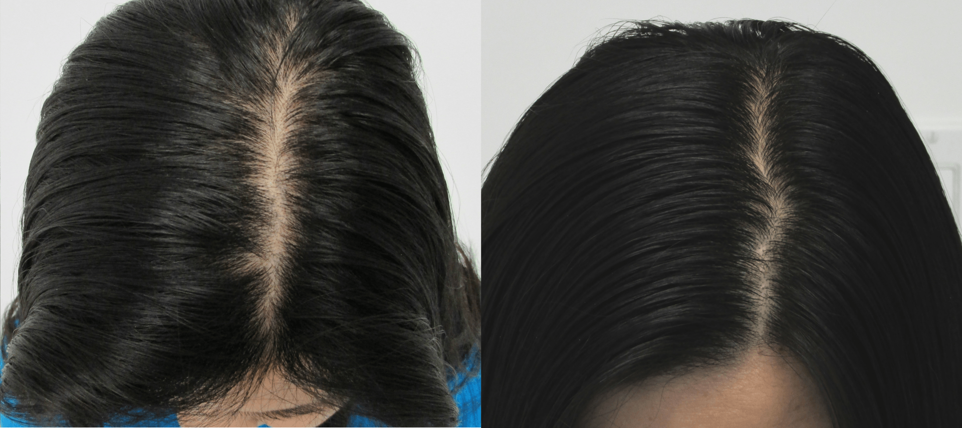 widening part hair regrowth before and after