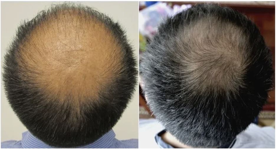 amazing hair regrowth by stop and regrow