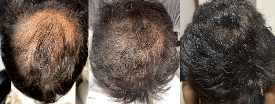 alopecia Treatment before and after