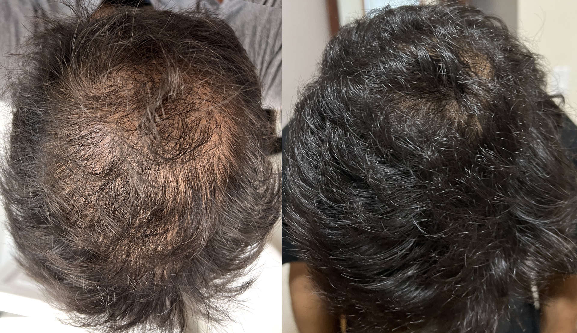 male telogen effluvium - hair regrowth treatment success