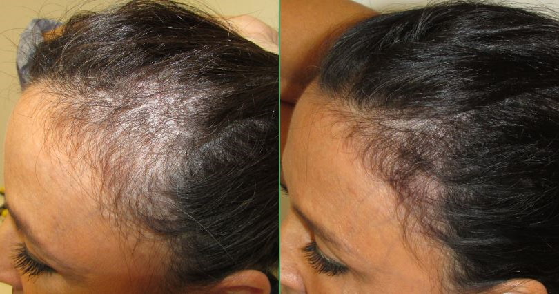 female pattern baldness hair regrowth before and after pictures