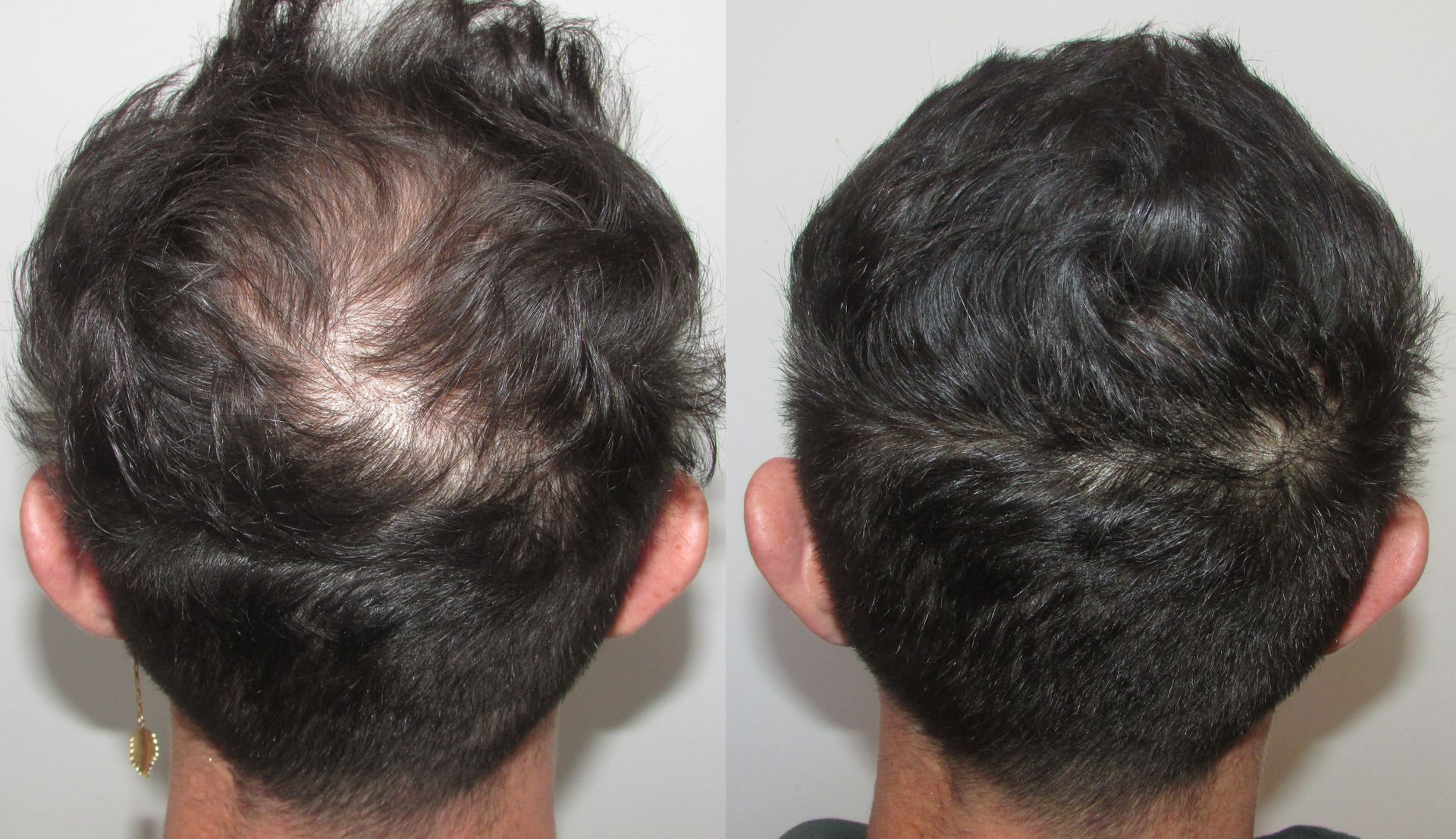 mens hair regrowth before and after shane