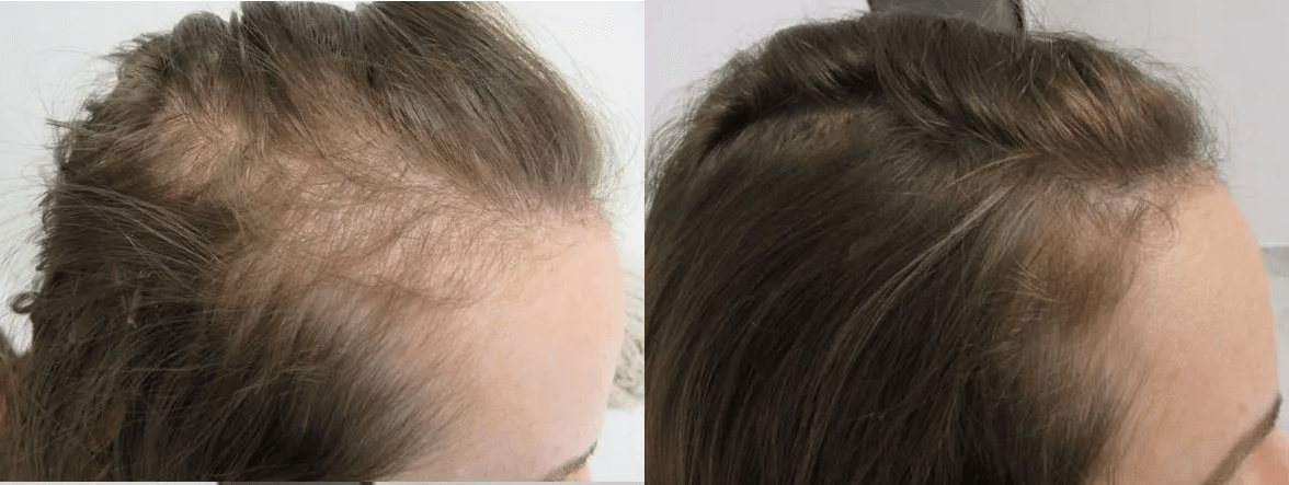 female hairloss diffuse thinning in temples