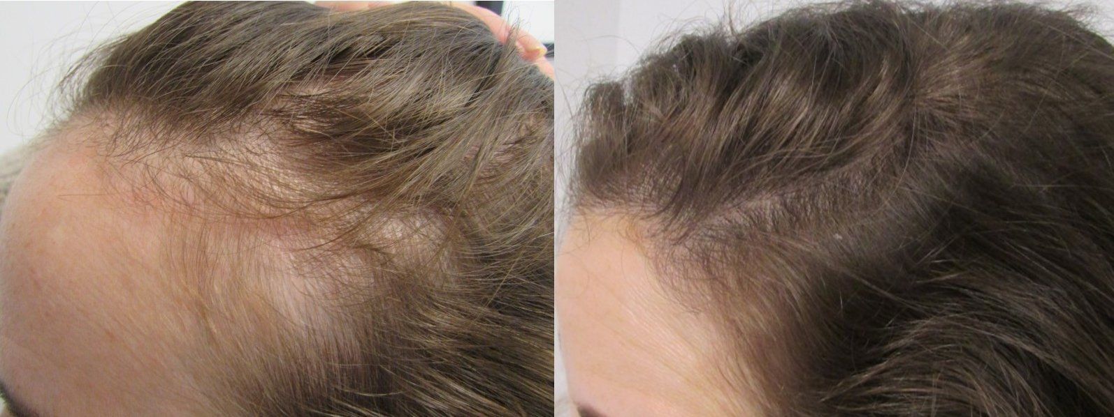 Telogen effluvium and androgenetic alopecia