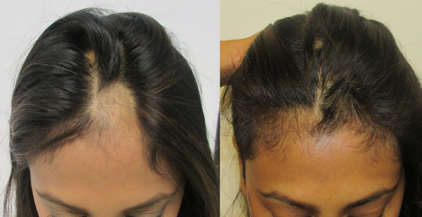 Before & After - Alopecia Areata Scalp Hair Regrowth.  Medical illustration of hair follicles on a healthy scalp versus hair loss caused by Alopecia Areata. A healthy follicle supports thick hair growth, while damaged follicles show patchy thinning.