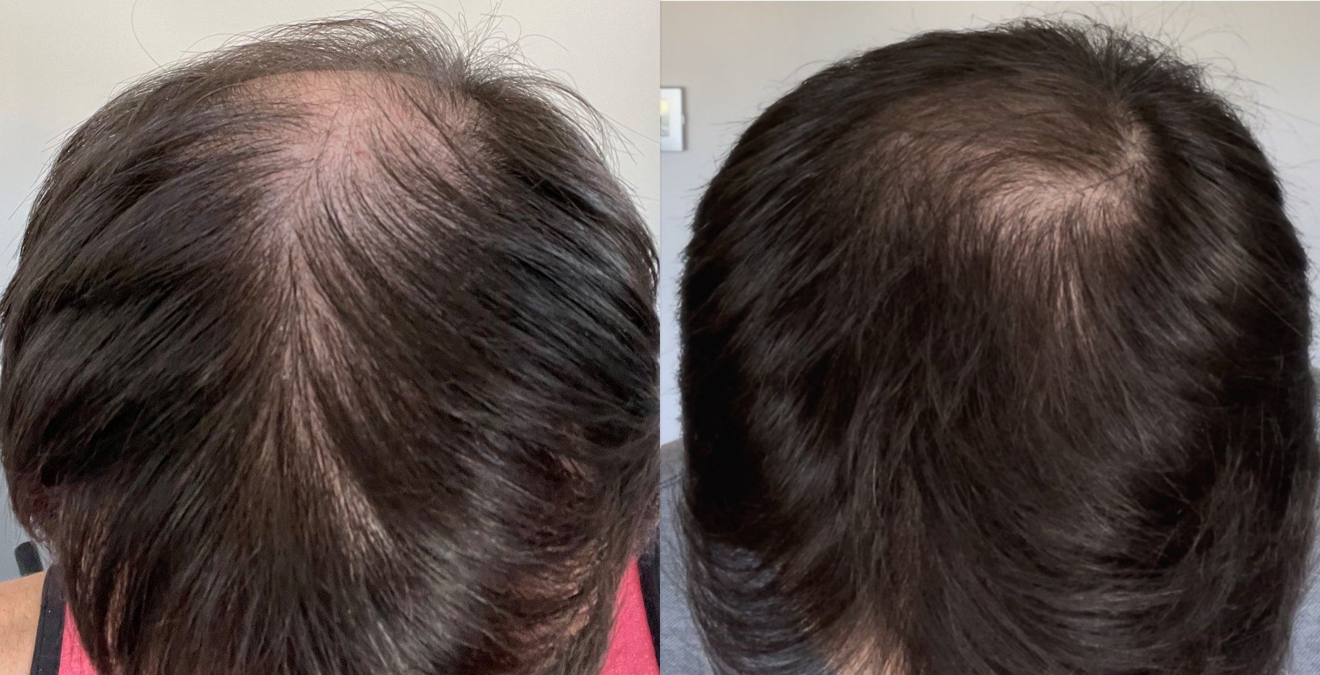 Hair Regrowth Treatment before and after 9 months Ryan
