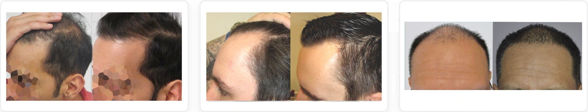 stop and regrow before and after pictures hair regrowth