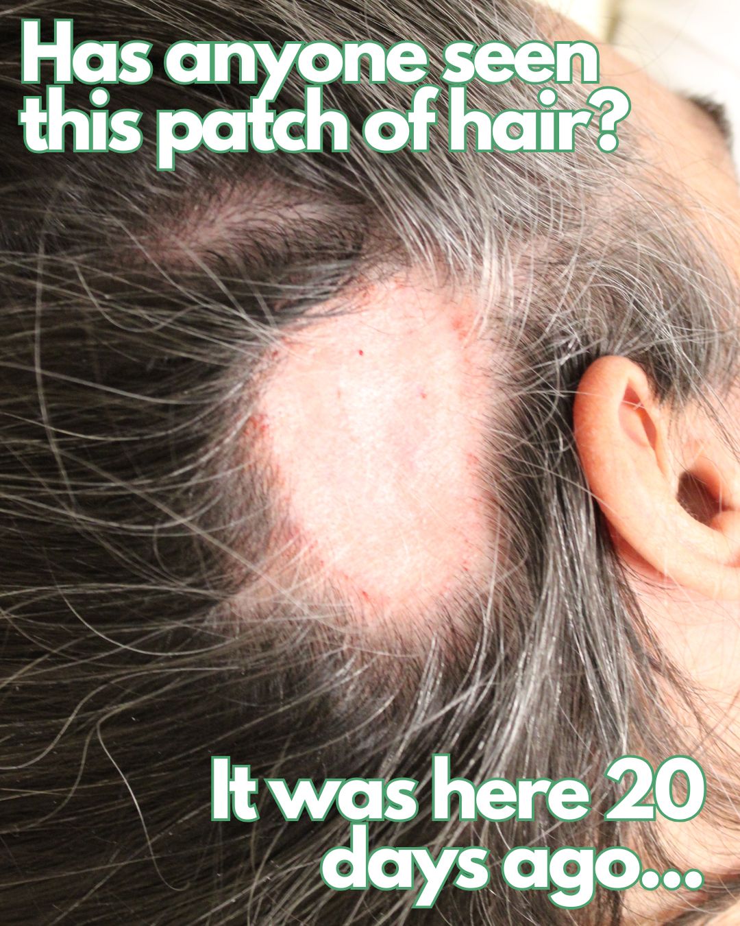 Alopecia areata - what is it and how to treat it