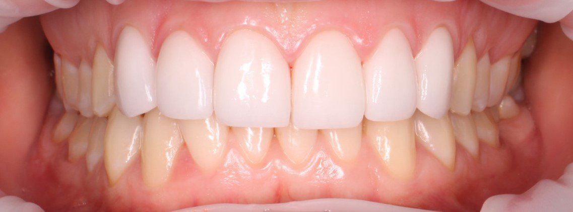 Port Smiles Dental after smile makeover services