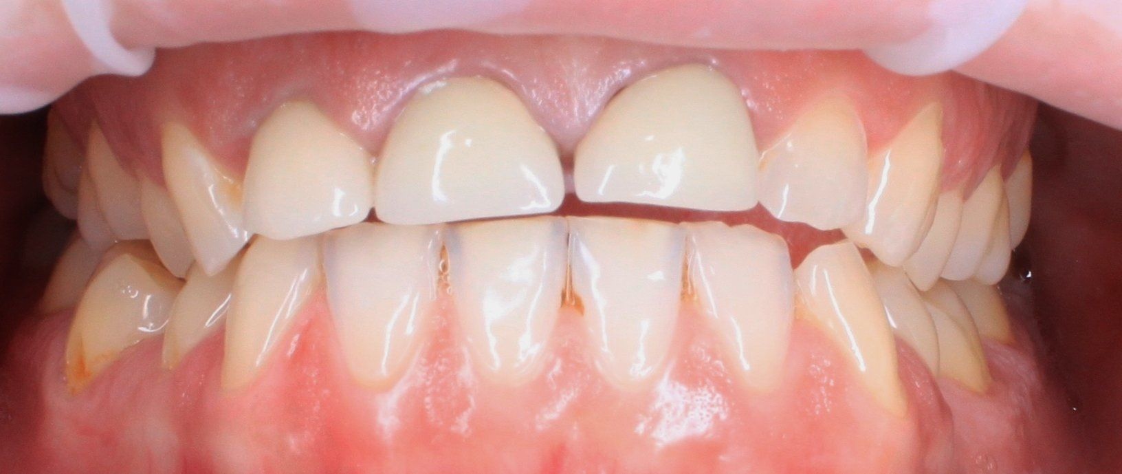 smile make over dental procedure