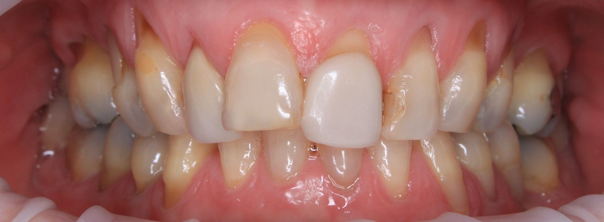 Port Smlies Dental before smile makeover