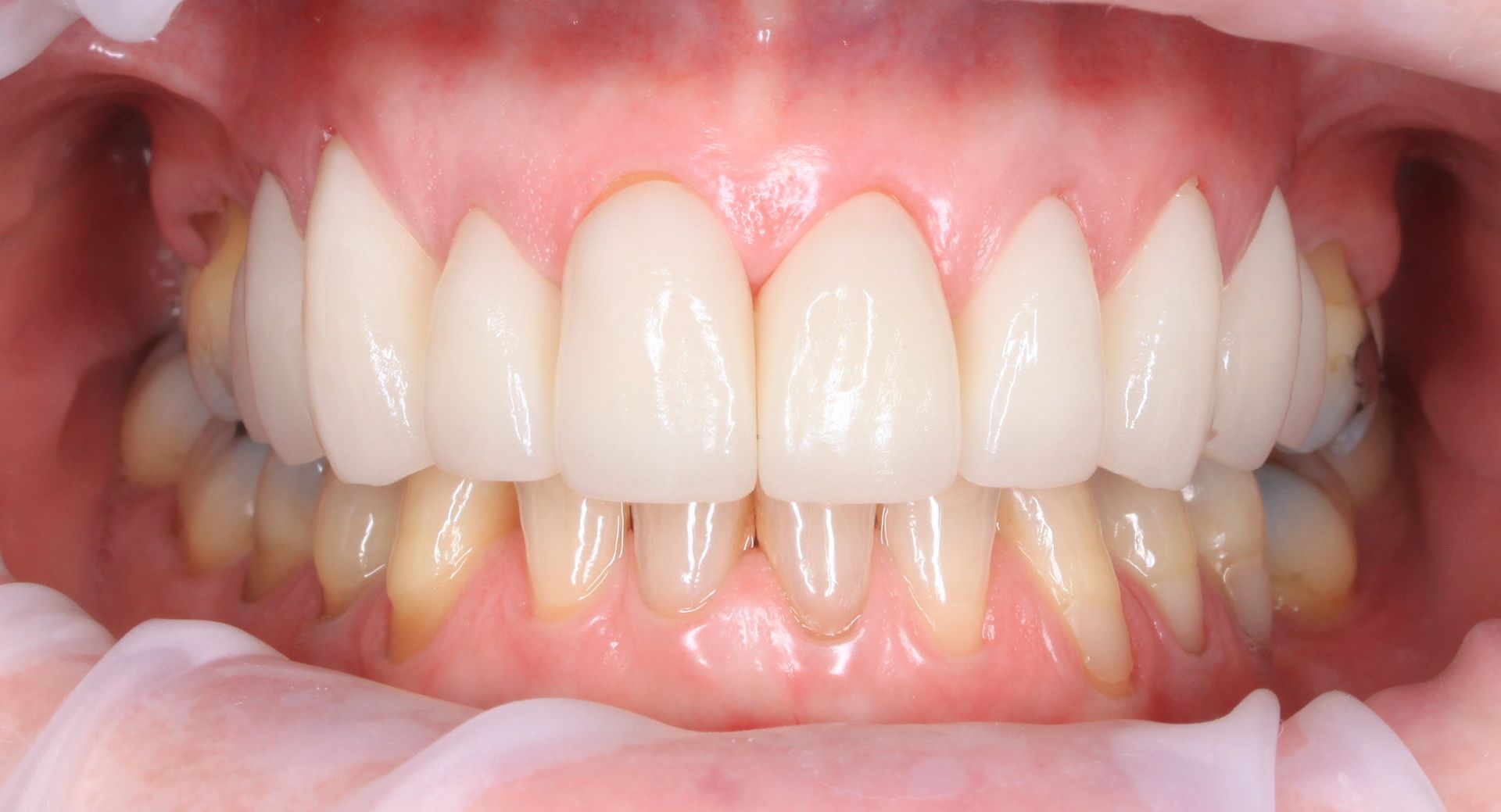 Port Smiles Dental after smile makeover services