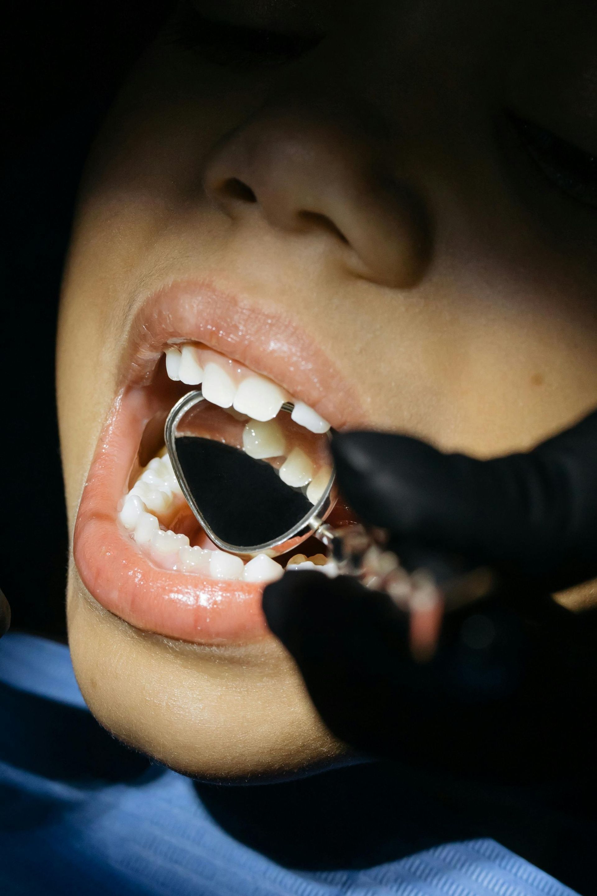 Person's mouth open during a dental checkup. A dentist's hand with mirror examines teeth in a bright setting.