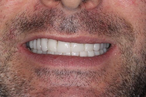 Close-up of a person's smiling mouth showing a full set of white teeth; lips are visible.