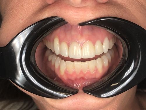 Teeth with a dental retractor in place; showing upper and lower rows of teeth.