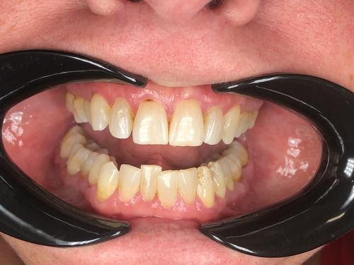 Open mouth with dental retractor, showing teeth with some discoloration and a small spot of blood.