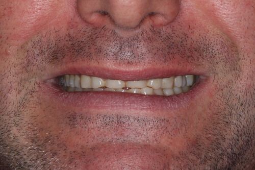 Close-up of a person's mouth with a slight smile, showing teeth and upper lip. Surrounding skin is visible.